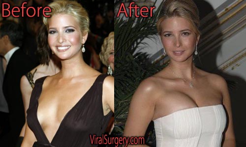 Melania Trump Plastic Surgery Before And After Video