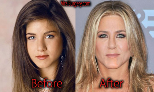Jennifer Aniston Plastic Surgery: Before and After Nose Job Pictures