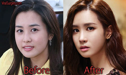 Lee Da Hae Plastic Surgery Before And After Jaw Surgery Pictures