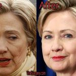 Hillary Clinton Plastic Surgery Before and After Pictures
