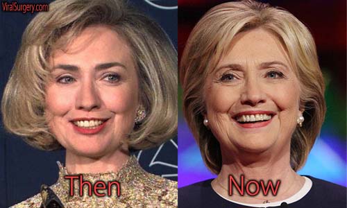 Hillary Clinton Plastic Surgery Picture