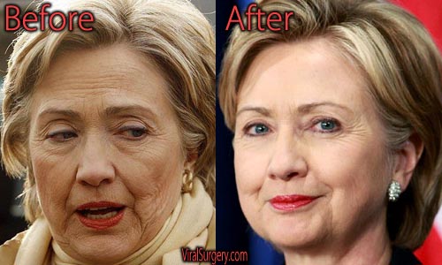 Hillary Clinton Plastic Surgery