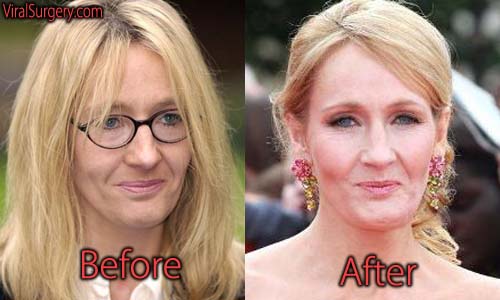 JK Rowling Plastic Surgery