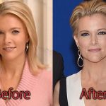 Megyn Kelly Plastic Surgery Before and After Pictures