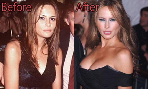 Melania Trump Plastic Surgery