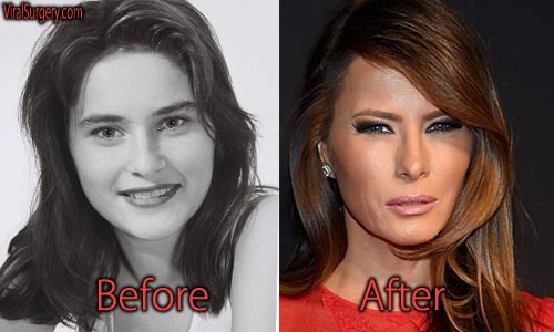 Melania Trump Plastic Surgery, Before and After Facelift Pictures