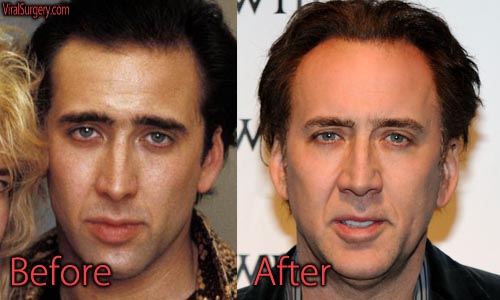 Nicolas Cage Plastic Surgery