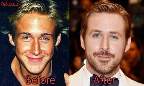 Ryan Gosling Plastic Surgery Nose Job