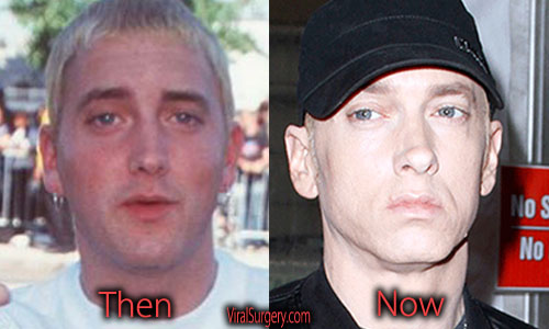 Eminem Plastic Surgery Facelift