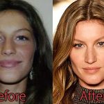 Gisele Bundchen Plastic Surgery Before and After Nose Job