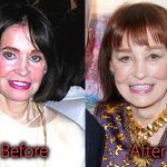 Gloria Vanderbilt Plastic Surgery Before and After Pictures