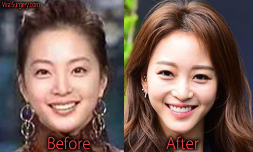 Han Ye Seul Plastic Surgery Nose