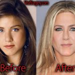 Jennifer Aniston Plastic Surgery Before and After Pictures