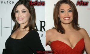Kimberly Guilfoyle Plastic Surgery, Before and After Botox Pictures