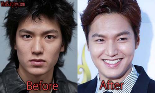 Lee Min Ho Plastic Surgery, Before and After Nose Job Pictures