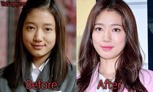 Park Shin Hye Plastic Surgery