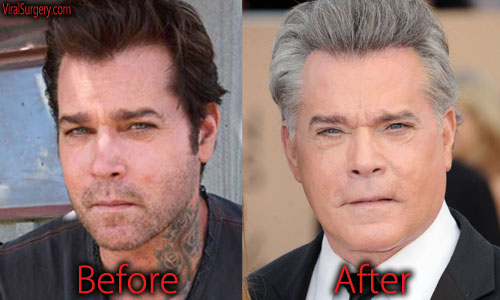 Ray Liotta Plastic Surgery Before and After Facelift.
