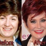 Sharon Osbourne Plastic Surgery Before and After Pictures