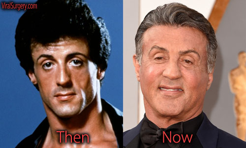 Sylvester Stallone Plastic Surgery Facelift