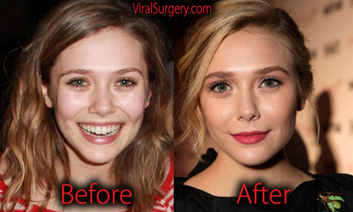 Elizabeth Olsen Plastic Surgery, Nose Job & Botox Photo.