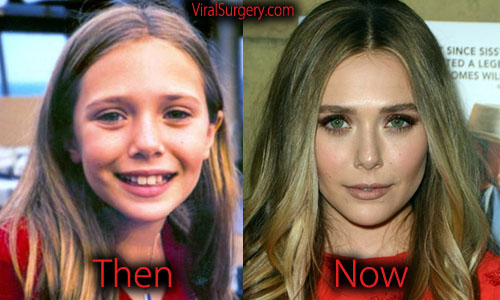 Elizabeth Olsen Plastic Surgery: Before and After Nose Job, Botox Pictures.
