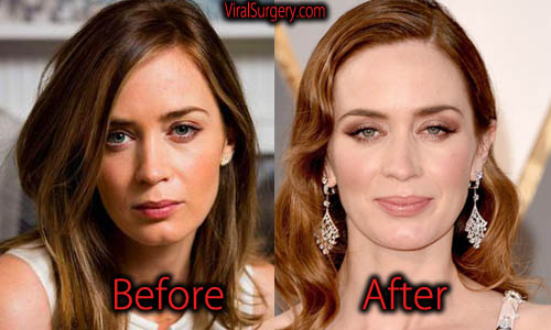 emily blunt nose job