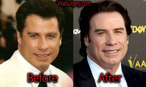 John Travolta Plastic Surgery