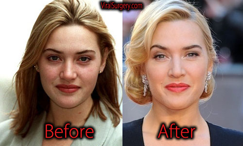 Kate Winslet Plastic Surgery