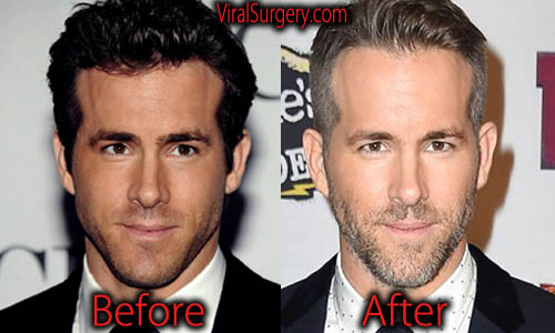 Ryan Reynolds Plastic Surgery Before And After Botox Pictures 