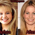 Candace Cameron Plastic Surgery, Before and After Botox Pictures