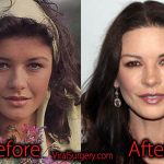 Catherine Zeta Jones Plastic Surgery, Before and After Facelift Pics