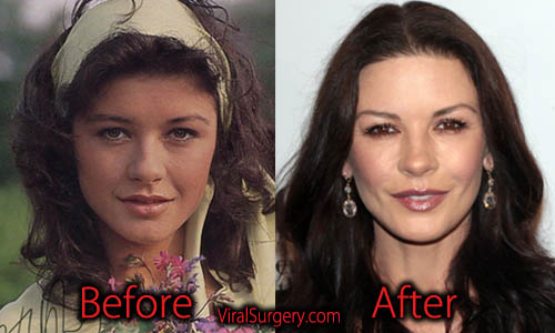 Catherine Zeta Jones Plastic Surgery
