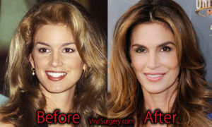 Cindy Crawford Plastic Surgery, Before and After Botox Pictures