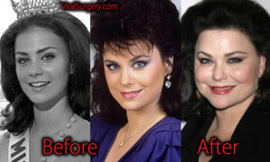 Delta Burke Plastic Surgery: Before and After Facelift ...