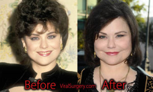 Delta Burke Plastic Surgery: Before and After Facelift ...