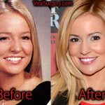 Emily Maynard Plastic Surgery, Before After Nose Job Pictures