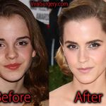 Emma Watson Plastic Surgery, Before and After Nose Job Pictures