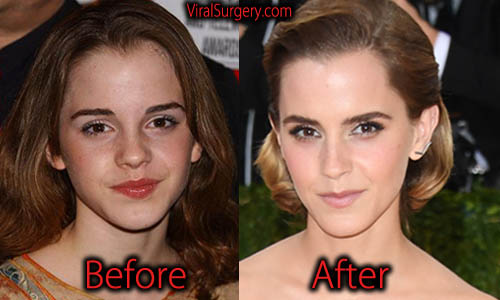 Reports of Emma Watson plastic surgery, especially for the nose job has spr...