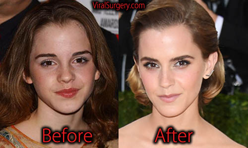 Has Emma Watson had plastic surgery? 