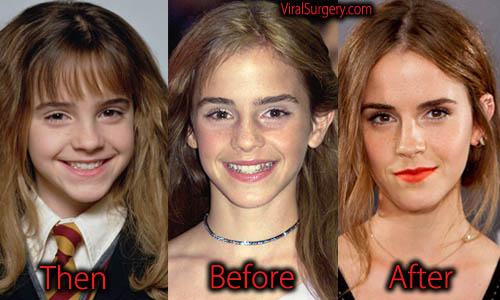 Emma Watson Plastic Surgery