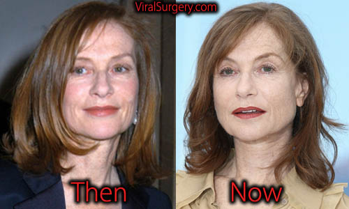 Isabelle Huppert Plastic Surgery, Botox