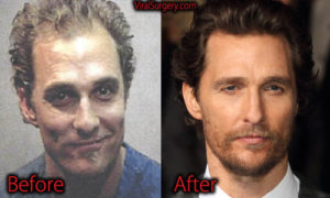 Matthew McConaughey Plastic Surgery: Hair Transplant, Before After Pict