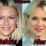 Naomi Watts Plastic Surgery, Before and After Botox Pictures