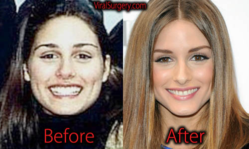 Olivia Palermo Plastic Surgery