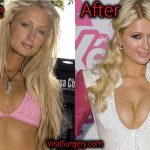 Paris Hilton Plastic Surgery Before After Nose Job, Boob Job Pics
