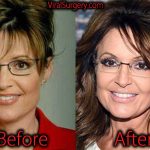 Sarah Palin Plastic Surgery, Before and After Botox Pictures