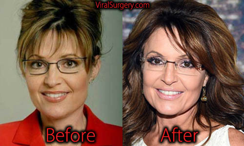 Sarah Palin Plastic Surgery
