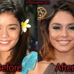 Vanessa Hudgens Plastic Surgery, Before After Nose Job Pictures