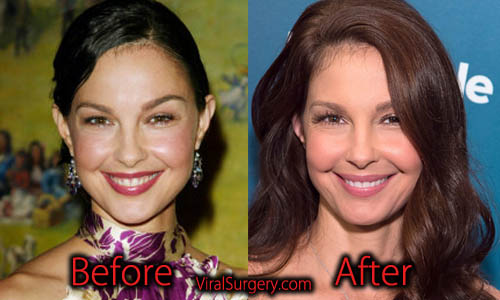 Ashley Judd Plastic Surgery