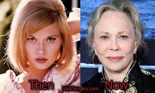Faye Dunaway Plastic Surgery Picture